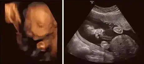 超声影像(四维彩超),帮你排除宝宝先天缺陷