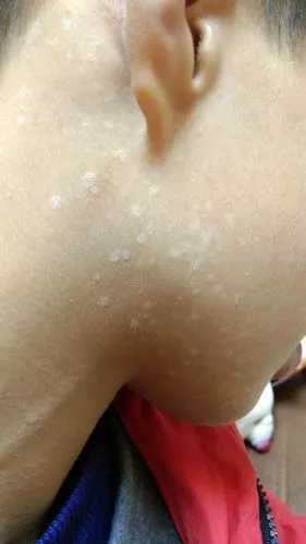 后背长花斑癣怎样治疗?如何彻底去除背部汗斑