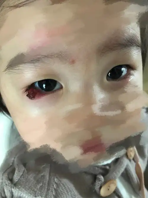 开贴说一说小朋友麦粒肿,霰粒肿(图片血 腥,慎入)