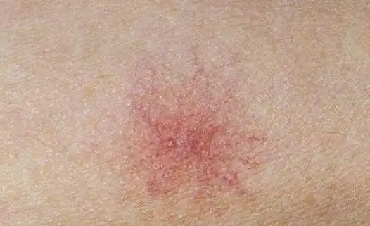 女子胸前长"红点",确诊肝癌,医生:皮肤出现这1症状,需警惕