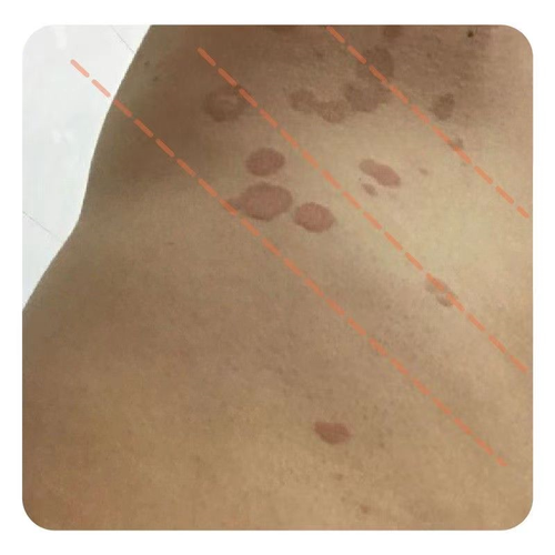 汗斑花斑癣马拉色菌丘疹汗斑净去汗斑药膏前胸后背白斑褐斑花斑癣