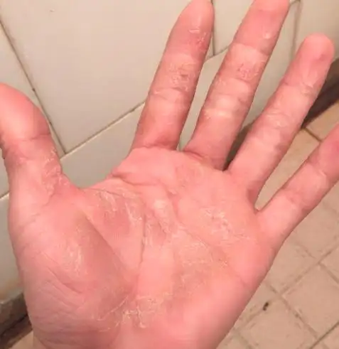 手皲裂性湿疹怎么治疗选对产品才能快速祛湿疹