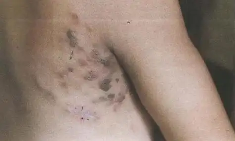 皮肤病需注意,患"艾滋病"皮肤也会出现异常,不要大意了