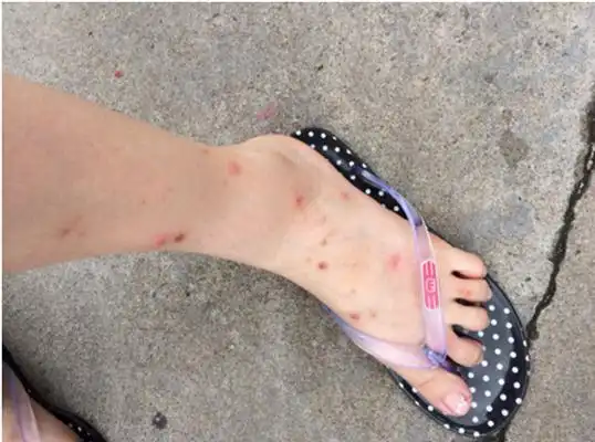 虫咬性皮炎图片 (132)