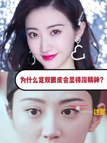 整了青蛙眼后的景甜重新美回巅峰,为什么宽双眼皮会显_圈子-新氧美容