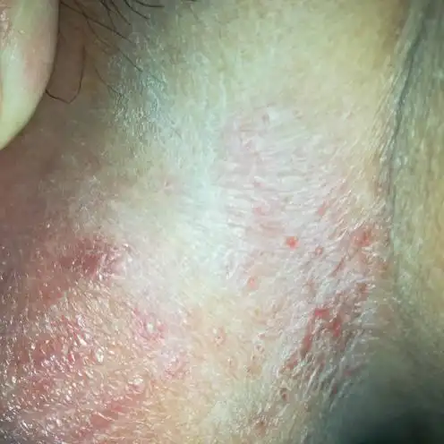 2018-12-28   展开全部 这个就是湿疹,买点去真菌药膏擦一擦就好了