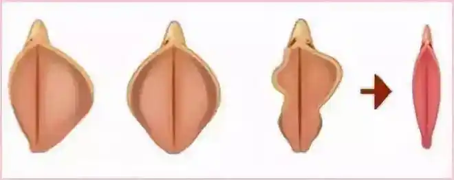 听完这几位女性的难言之隐突然明白了私密整形的重要性