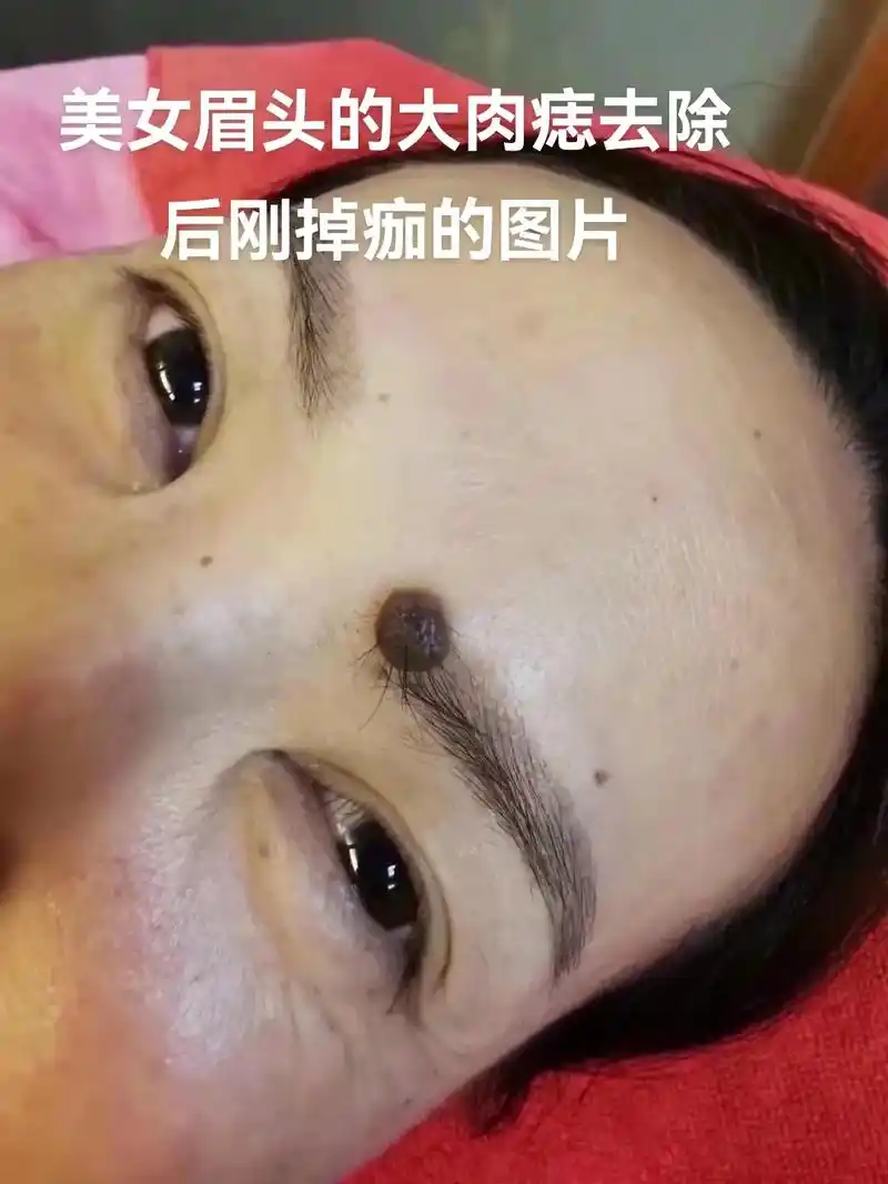 美女十天前来点的大肉痣,今天刚脱落拍的照片#大悟美容九年老店 - 抖