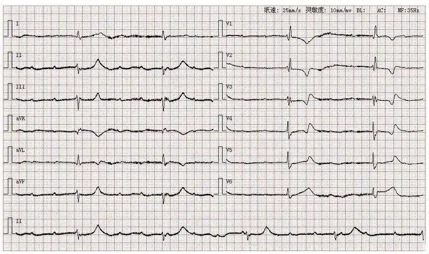 心电图库丨三度房室传导阻滞系列_心律_窦性_患者