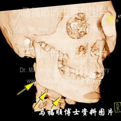 下颌骨雕刻瘦脸整形术