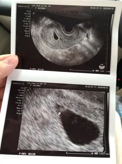 怀孕六周,阴超胎囊8.3mm还看不清楚里面,孕囊大小健康不