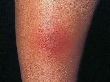 人工性脂膜炎的症状和图片 - 有来医生