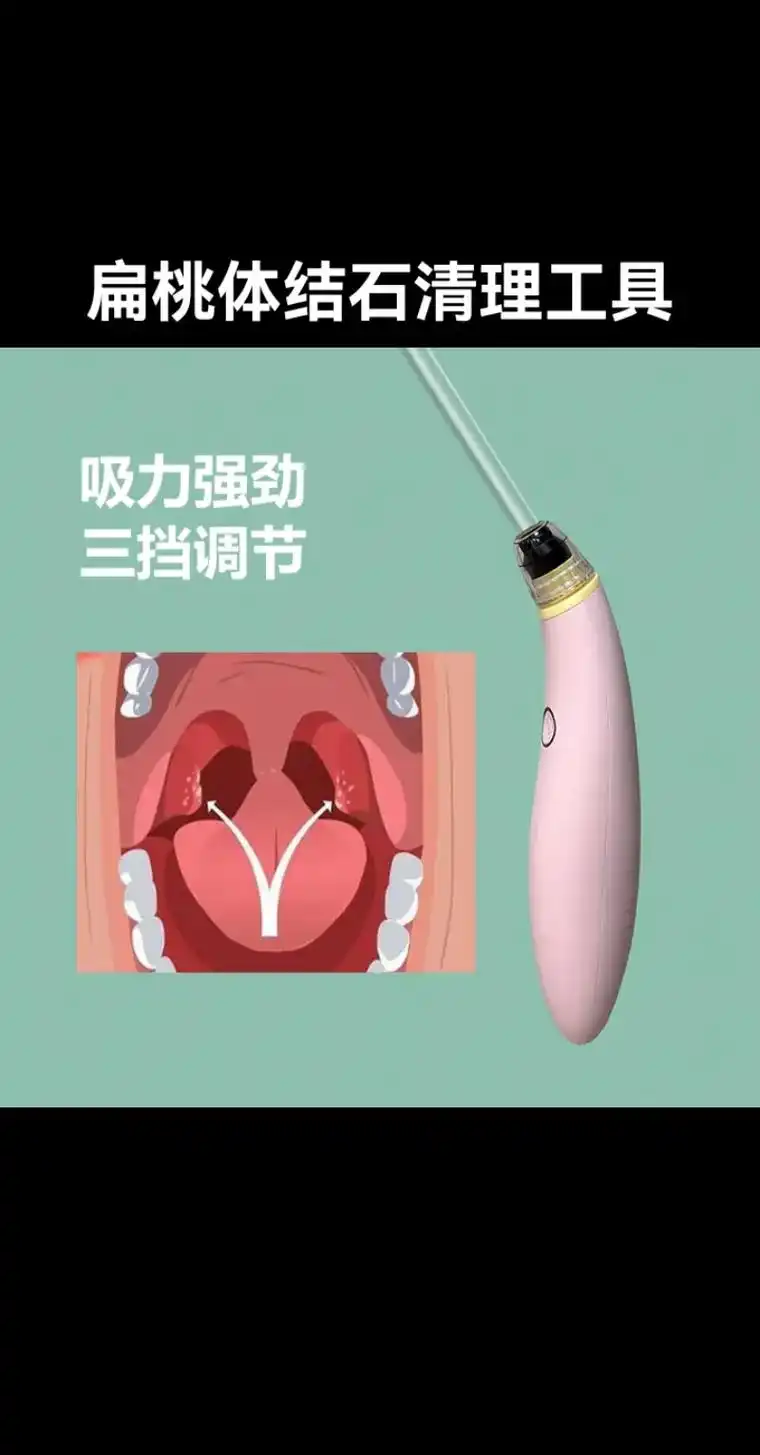 扁桃体结石清理工具