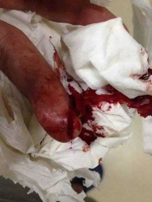 割伤手腕的图片流血,手腕割伤图片真实流血男人-图片大观-奇异网