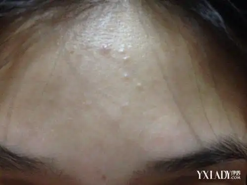 【图】额头上长粉刺怎么办 消除粉刺的三个方法