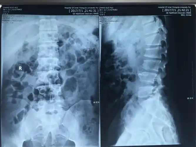 张xxx 男 39岁.腰二三椎间盘突出 严重挤压马尾神经病例