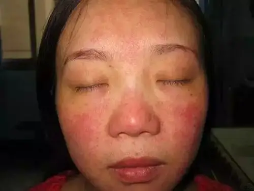 警惕铅汞斑经常化妆的女性千万要注意