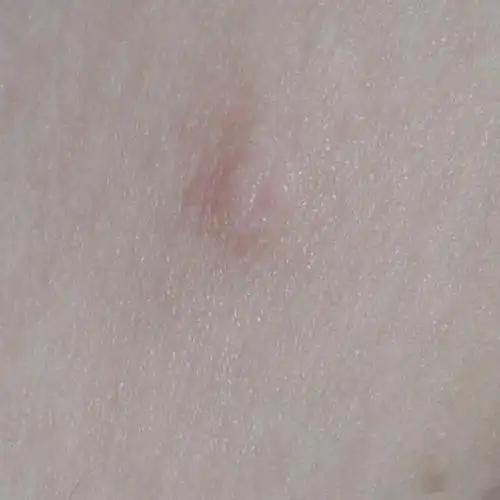 我两边腋下都长了这个像乳头的东西,这个到底是什么啊,有点担心.