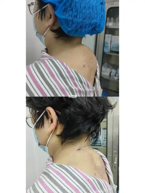 今日份日常工作较大富贵包微创去除