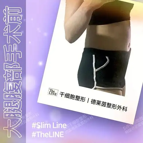 韩国德莱茵干细胞腹部吸脂,比一般的吸脂恢复更快,再生能力更强.