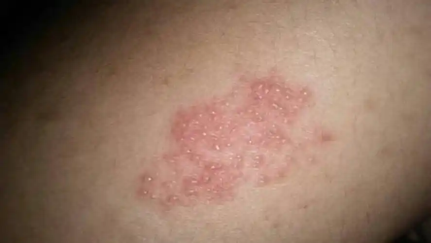 水疱疹怎么治疗水疱疹图片水疱疹儿童图片水疱疹水疱或大疱损害水疱性