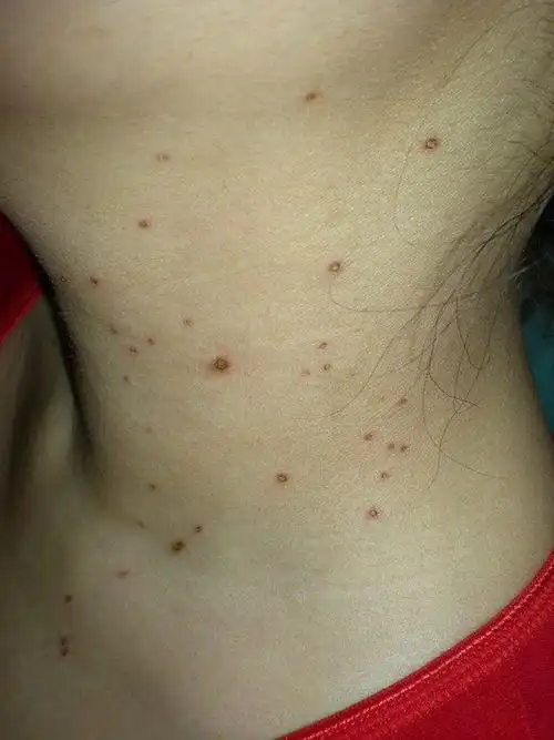 丝状疣的对比图片