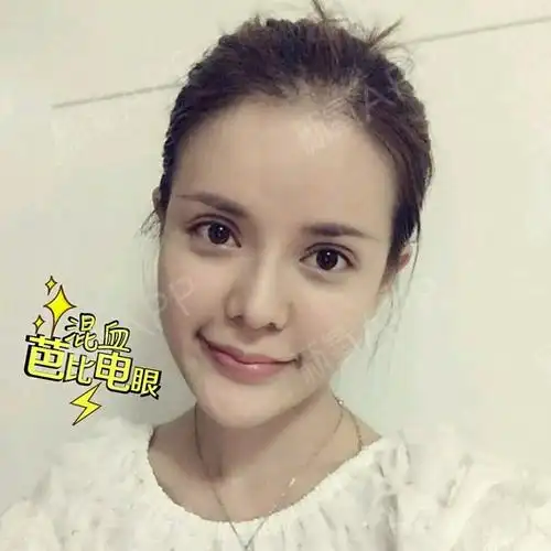 欧式全切双眼皮术后第十天