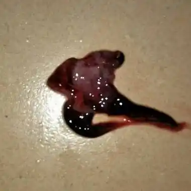 请问是不是流产