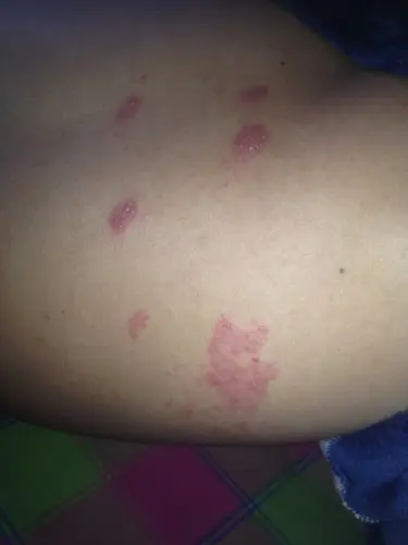 病毒性疱疹是不是可以自愈啊?下面这两张图片是不是疱疹?