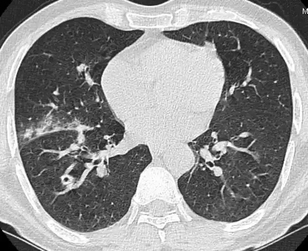 7种肺部常见空洞性疾病