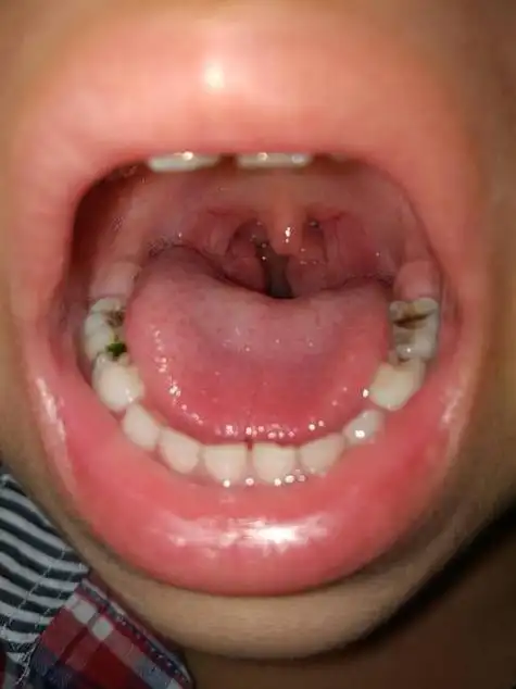 小孩嗓子红怎么办?(宝宝嗓子红了什么样)