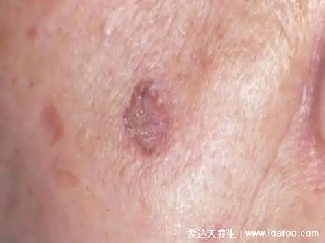 皮肤溃疡,病症以及牛皮癣,湿疹,炎症十分类似,但鳞状细胞癌要严峻良多