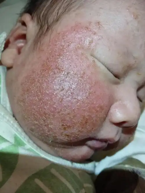 湿疹之经验教训总结