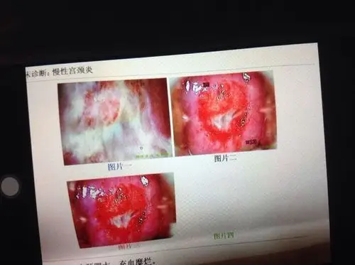 你好,能帮我看一下这个图片显示的宫颈严重
