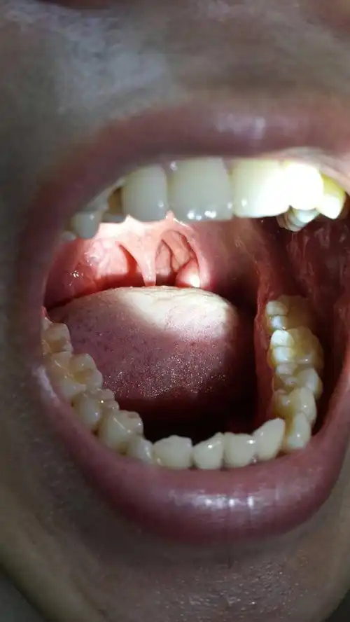 喉咙上面长了一颗白色的东西,长了大概有几个星期了