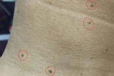 丝状疣会带来哪些危害?