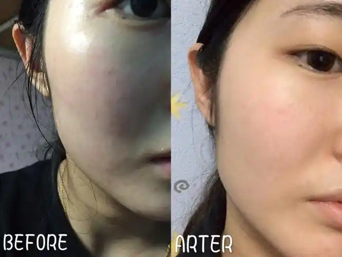 国货之光敏感肌红血丝救星—薇诺娜舒敏保湿修红霜