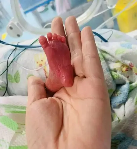 播种爱心,守护生命——出生10天手术2次,这个850克的宝宝想活下去!