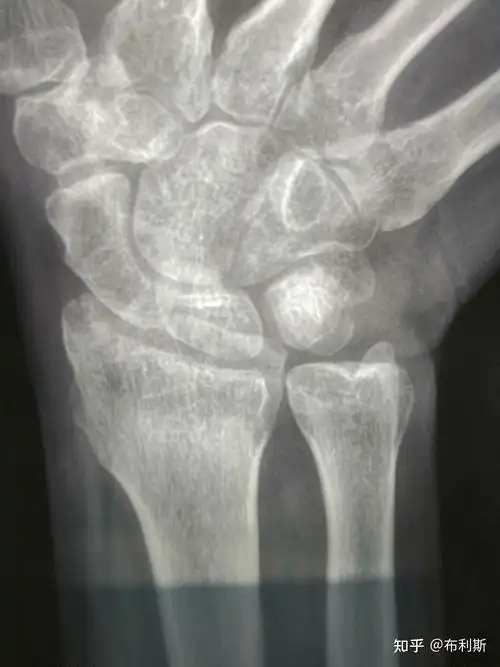 右手腕舟状骨骨折