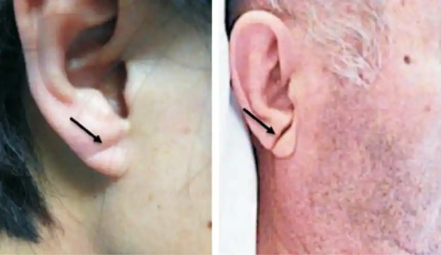 耳垂有折痕是心梗的标志?辟谣:可以警惕风险,但不应划等号