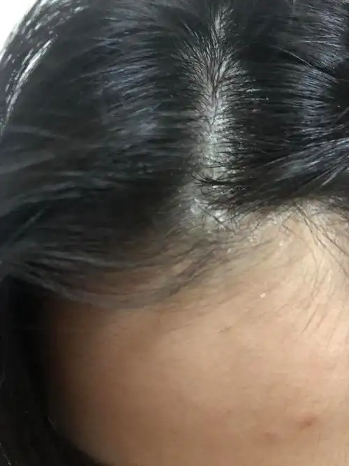 头上都是块状的鳞屑超级痒脂溢性皮炎求助