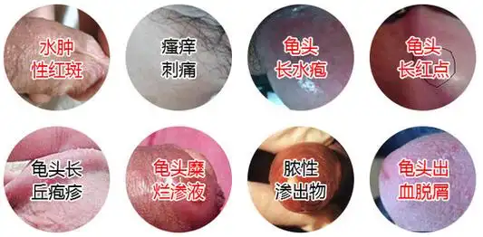(4)急性浅表性龟头炎的症状:初起局部潮红,阴茎皮肤发红,肿胀,龟头有