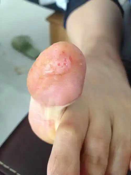 脚趾趾尖处从今年四月份开始就开始出深在性水泡,初期壁厚,在皮下呈小