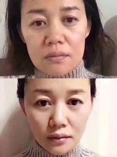 适用于线雕大v线的情况有哪些