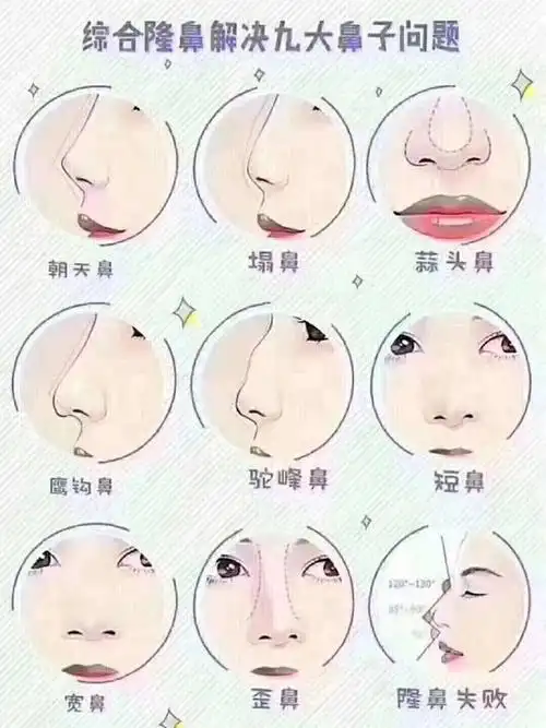 鼻部整形攻略
