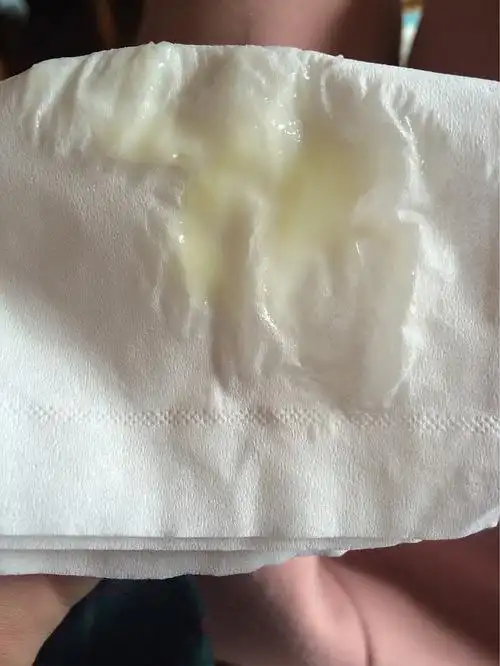 去医院检查中度宫颈糜烂 tct正常 白带查不出菌 到底怎么回事?