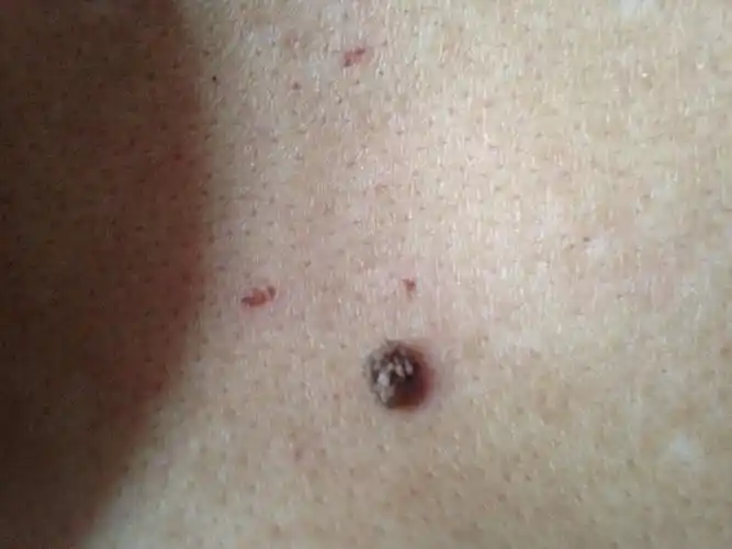 后背脊骨地方长了一个肉阄,就像花一样有很多很多的小花瓣,请问专家这