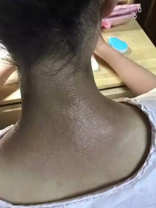 孩子晒黑的脖颈