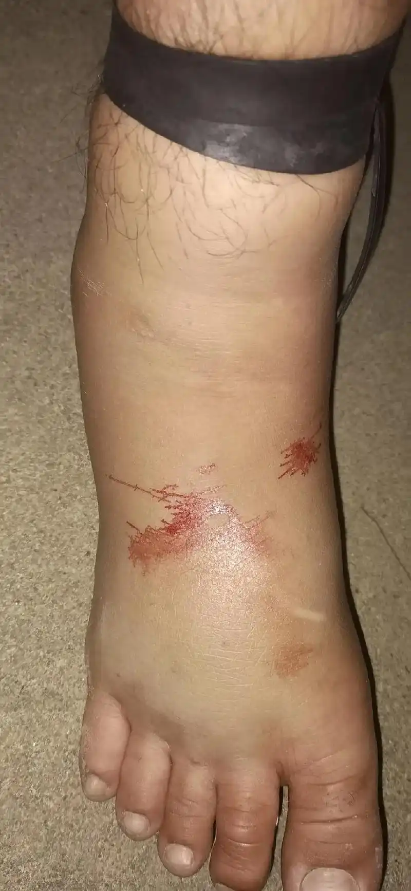 午夜12点多了,三小时前这位帅哥不慎被毒蛇伤,伤口肿胀疼痛难 - 抖音