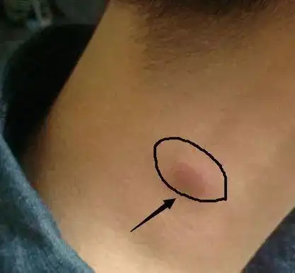 【报警】脖子莫名起包块,很可能是肿瘤?!专家教你初步识别_ 淋巴